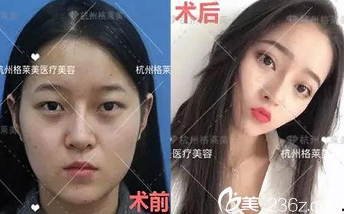 杭州整容爆料案件最新情况,真相逐步浮出水面